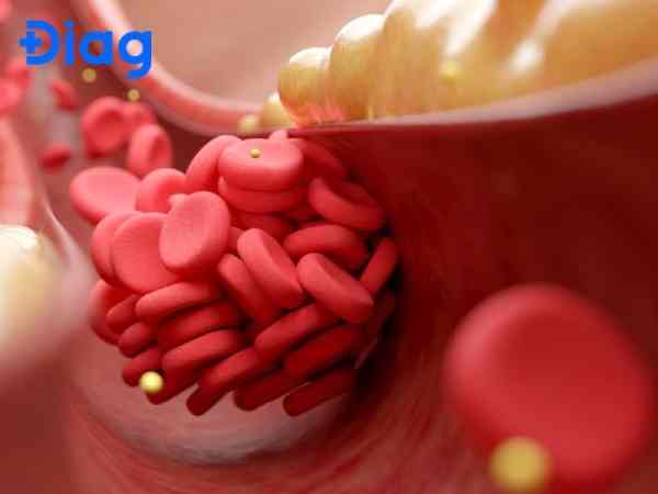 Chỉ số cholesterol hoặc huyết áp tăng cao