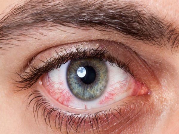 Phân tích chi tiết từng dạng mắt có tia máu đỏ